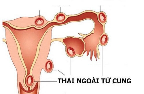 Viêm lộ tuyến cổ tử cung cấp độ 2 làm tăng nguy cơ mang thai ngoài tử cung